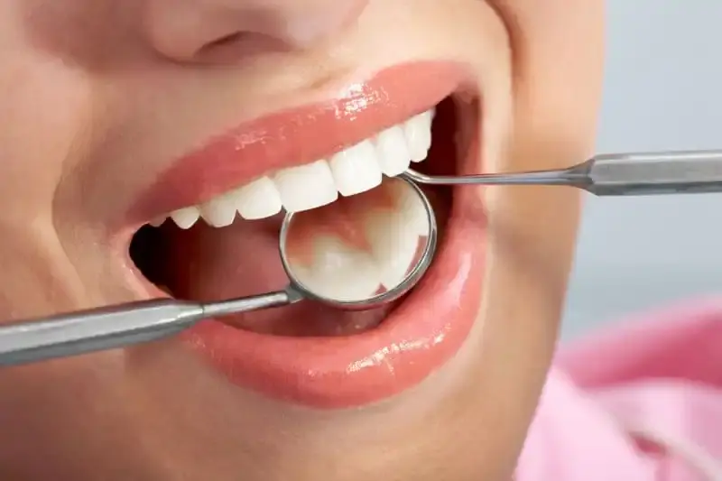Composite Fillings