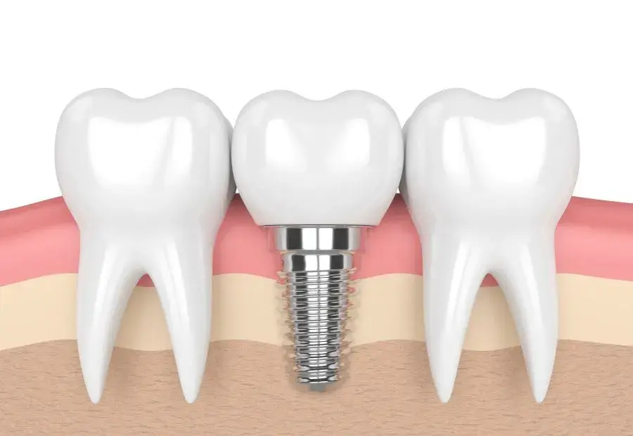 Dental Implants
