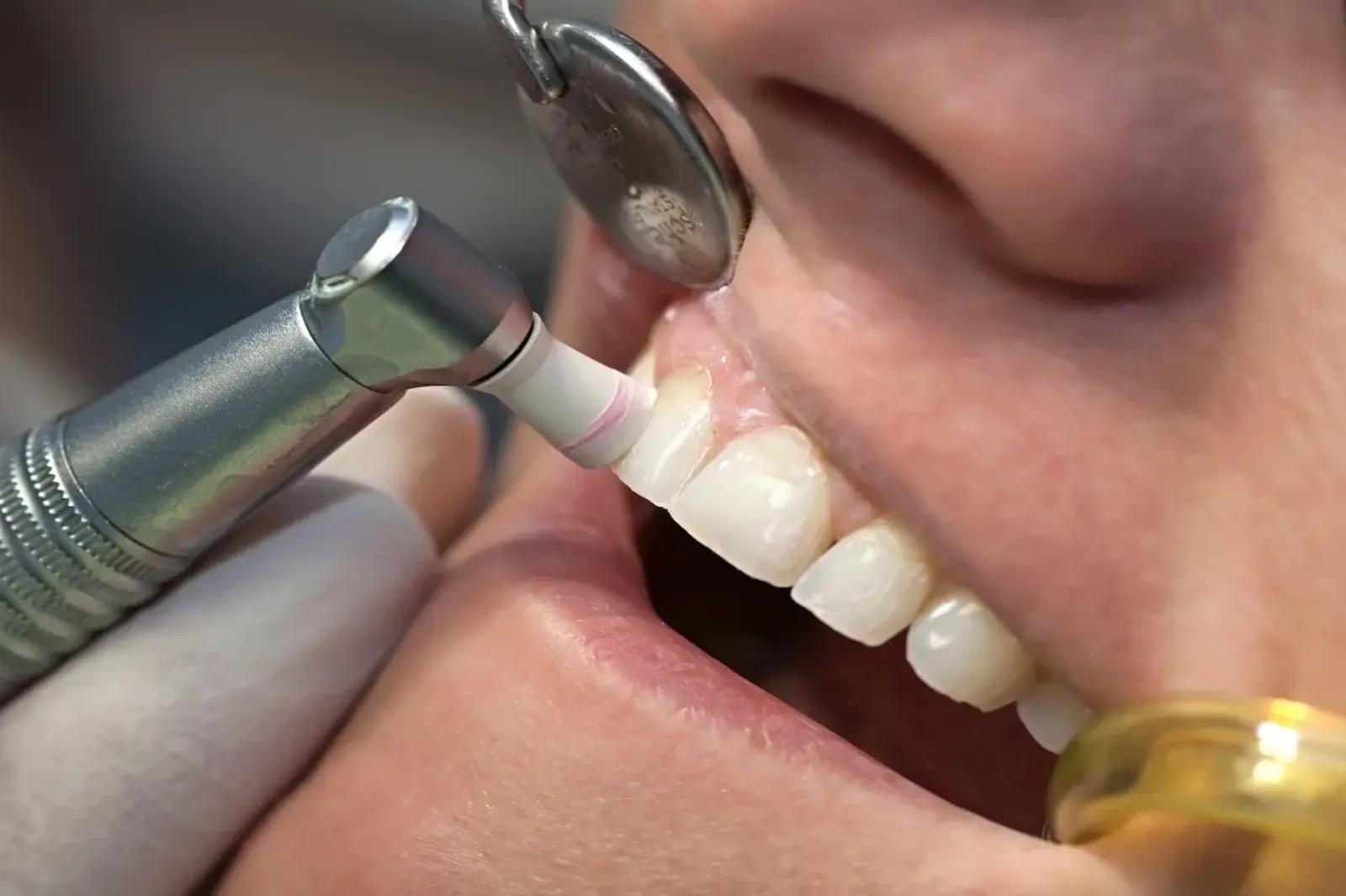 Teeth Cleaning at Bellevue Family Dentistry