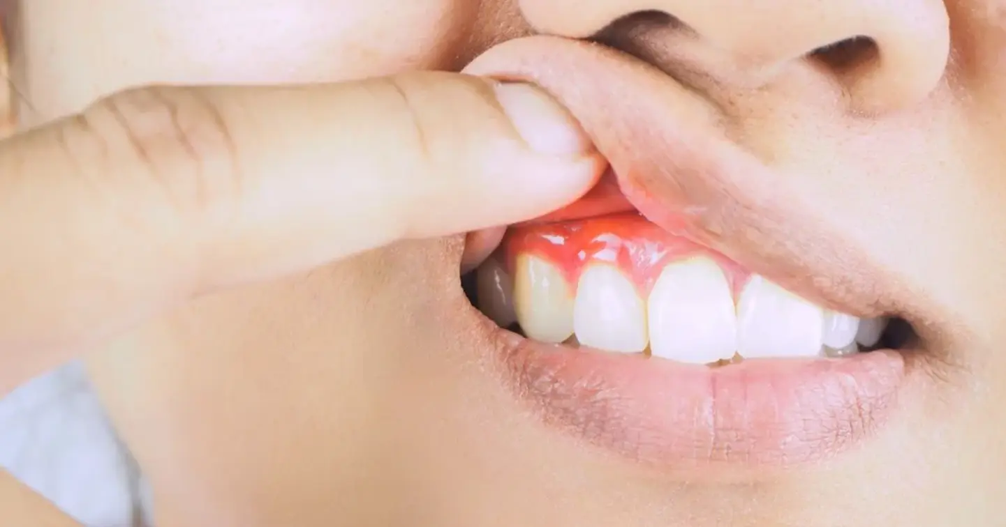 Periodontal Therapy at Bellevue Family Dentistry