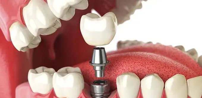 Dental Implant Open Jaw