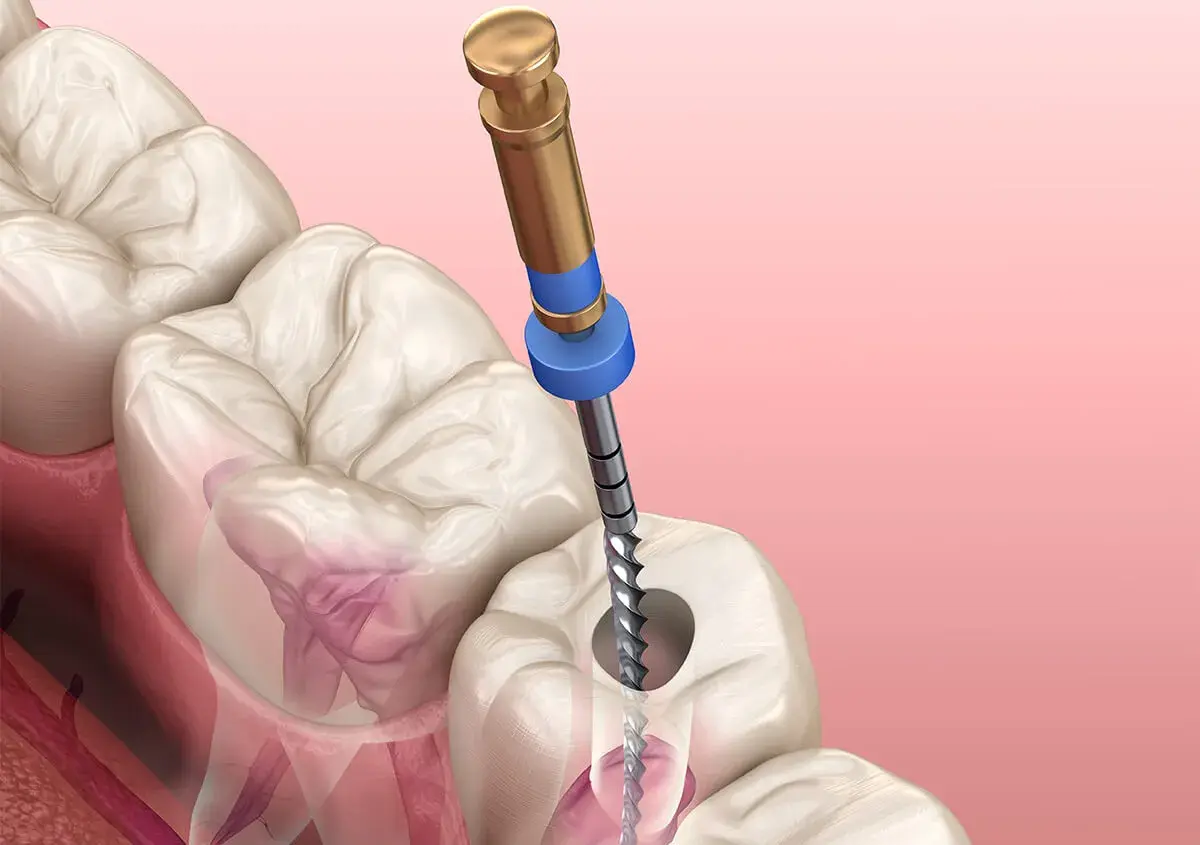 Root Canals